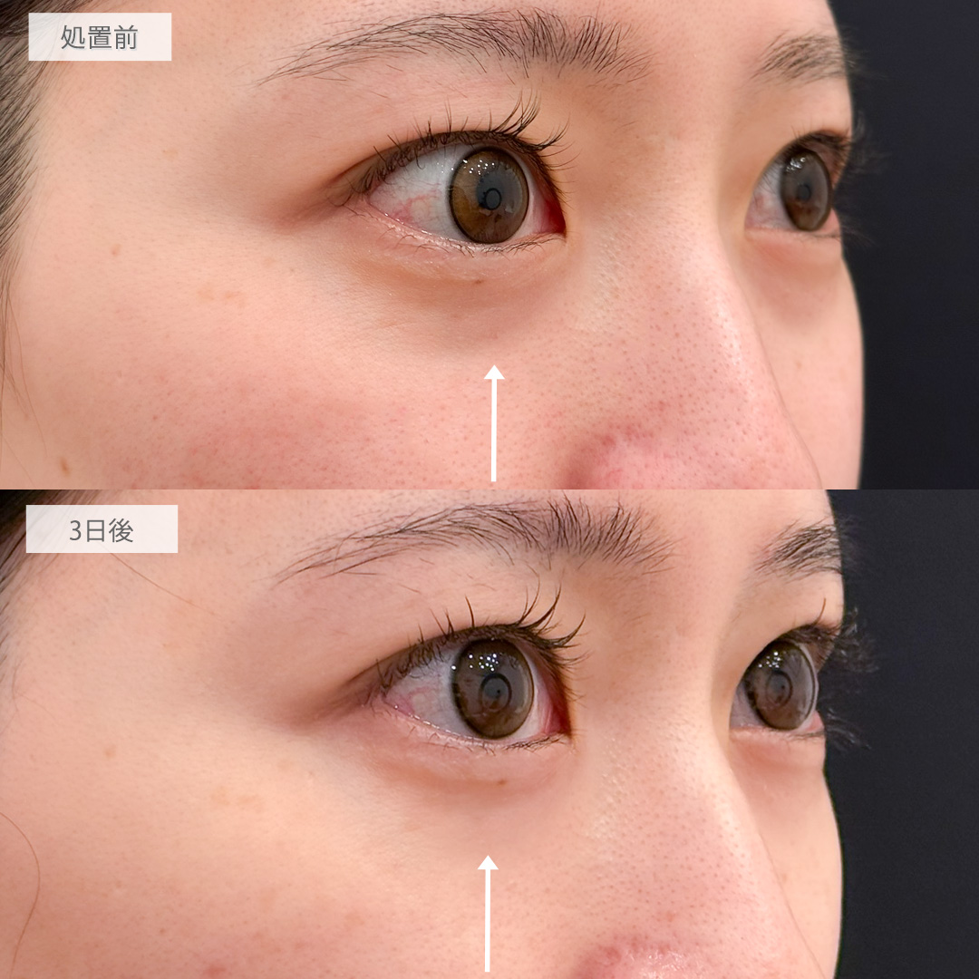 A式コンシーラー注射でクマを軽減し疲れ顔と老け顔を改善！処置前と3日後の症例です(20代女性)