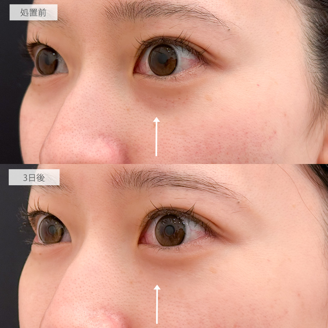 A式コンシーラー注射でクマを軽減し疲れ顔と老け顔を改善！処置前と3日後の症例です(20代女性)