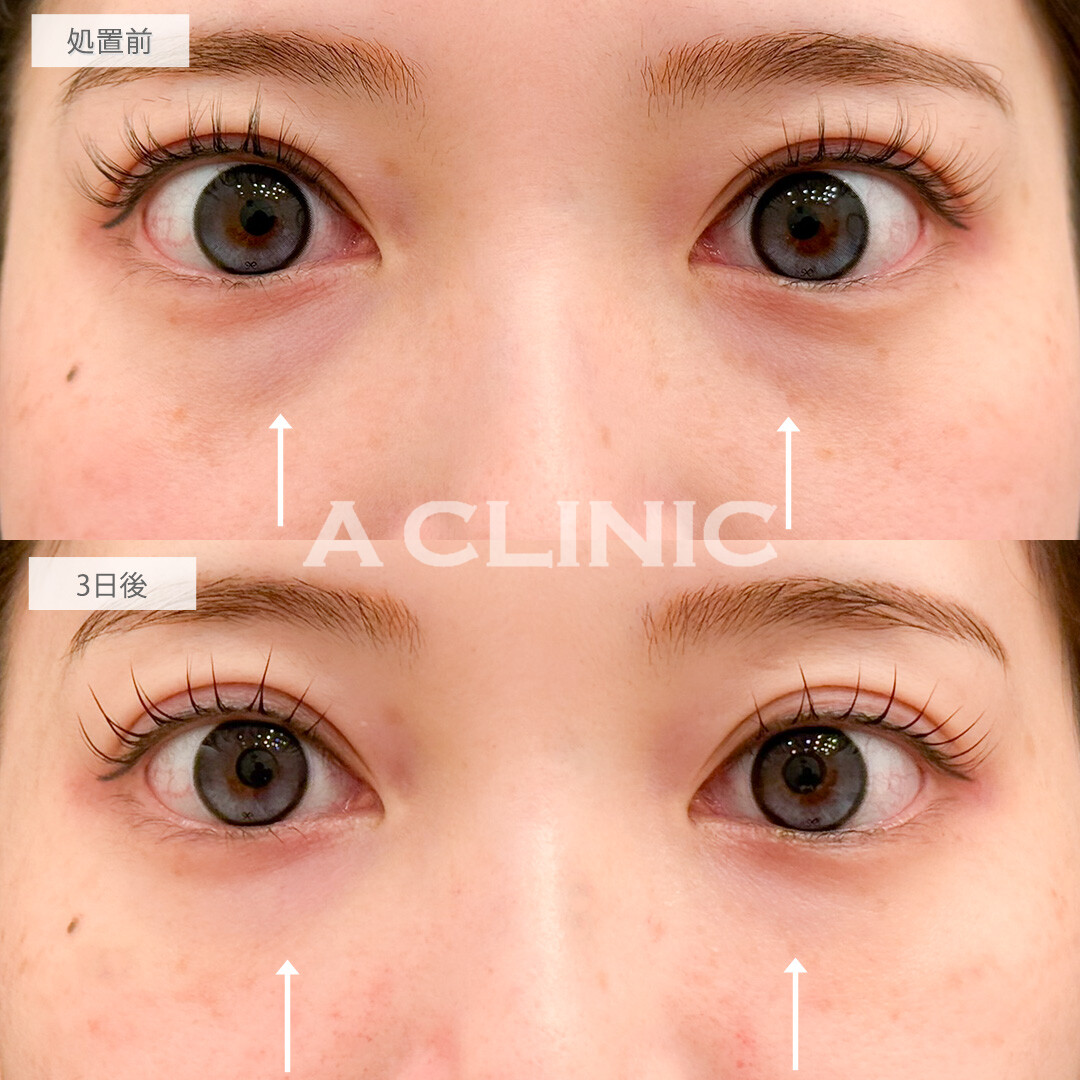 A式コンシーラー注射で崩れやすかった目元のメイクも楽になりました！処置前と3日後の症例です(20代女性)