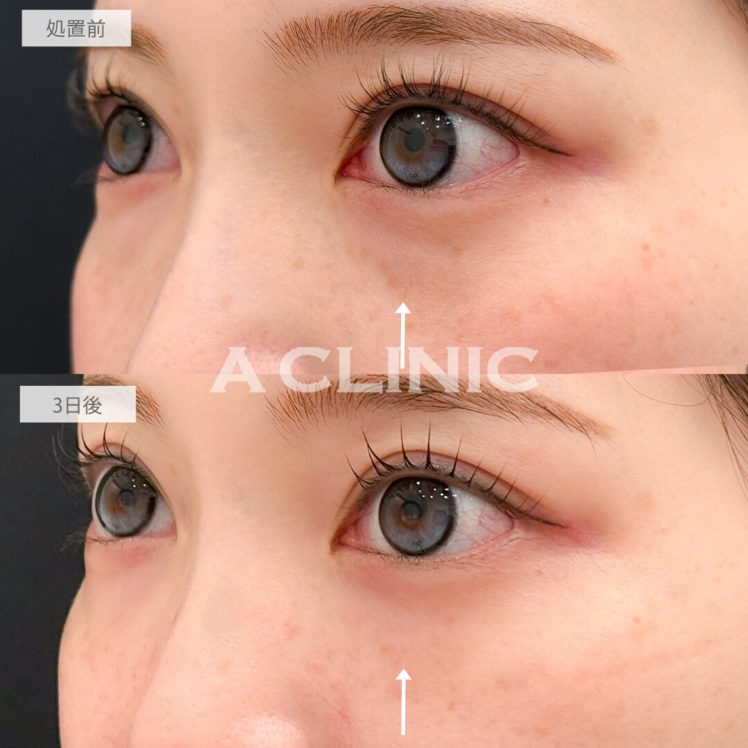 A式コンシーラー注射で崩れやすかった目元のメイクも楽になりました！処置前と3日後の症例です(20代女性)