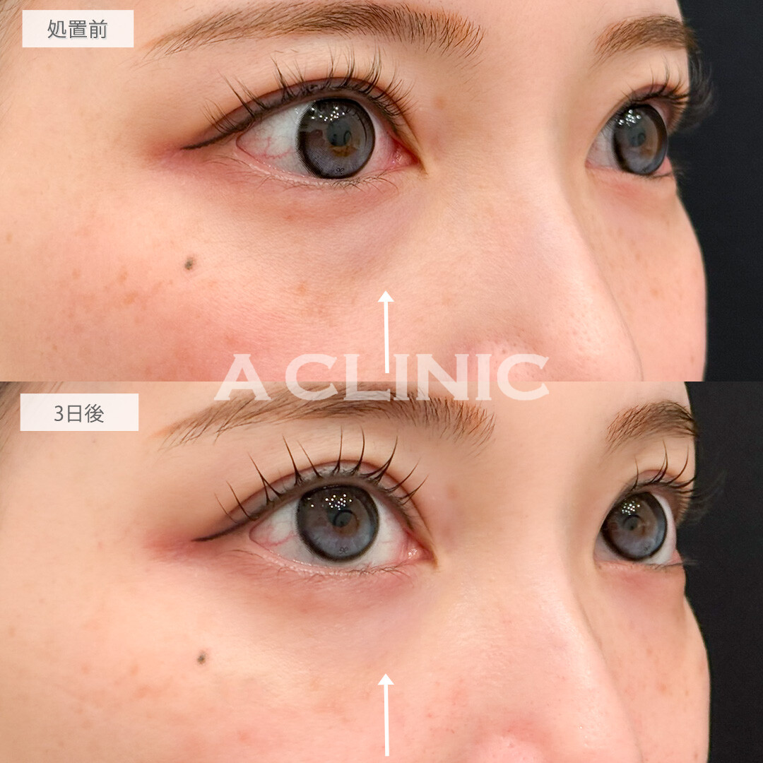 A式コンシーラー注射で崩れやすかった目元のメイクも楽になりました！処置前と3日後の症例です(20代女性)