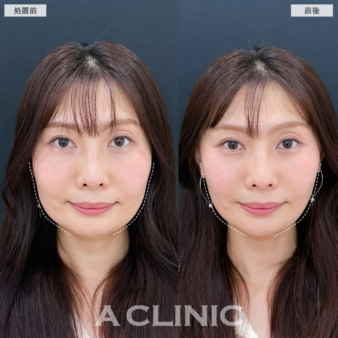 Aスレッドで口元全体のたるみが引きあがり若返りました！こちら処置前と直後の症例です(40代女性)