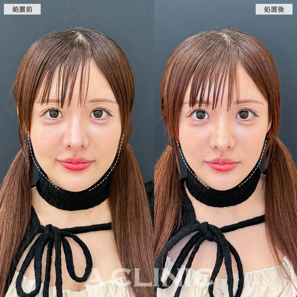 Aスレッドで口横のもたつきが解消し洗練された輪郭に！こちら処置前と直後の症例です(30代女性)