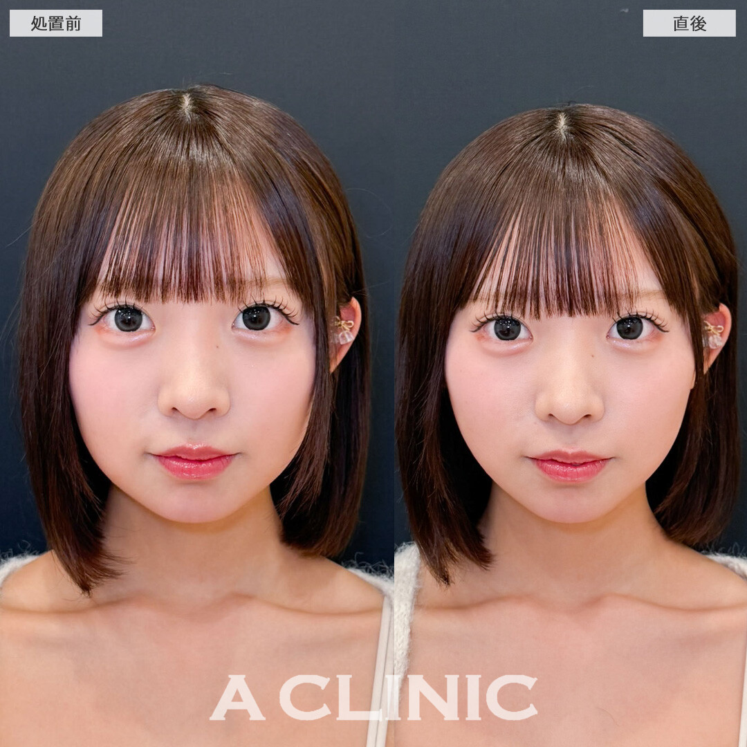 Aスレッドで丸みは残しつつ自然にリフトアップ！こちら処置前と直後の症例です(10代女性)