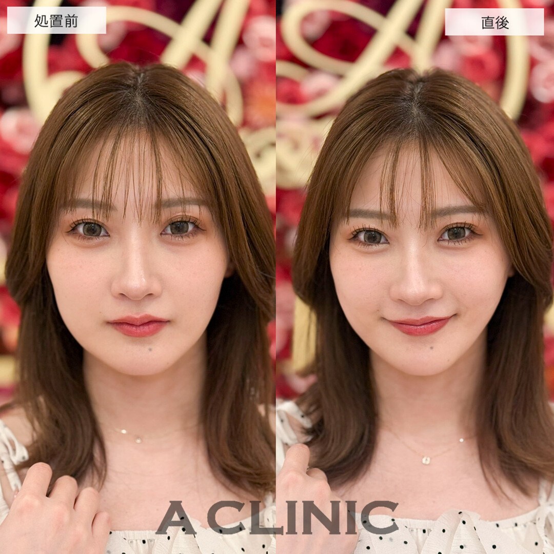 Aスレッドで左右差改善し小顔になることで他のパーツが際立つようになりました!こちら処置前と直後の症例です(20代女性)