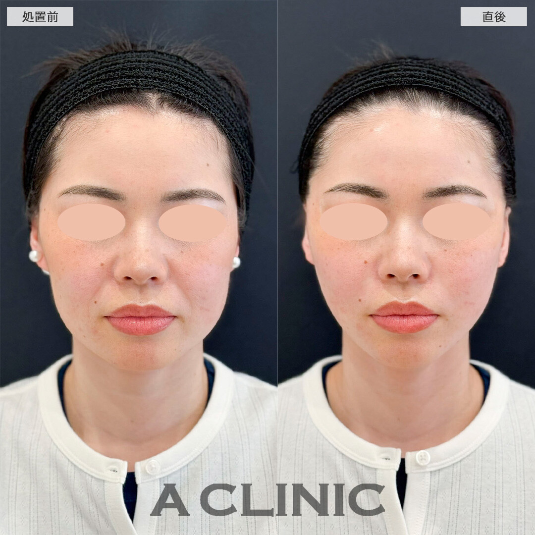 Aスレッドで周りにバレずにたるみ撃退！処置前と直後の症例です(30代女性)