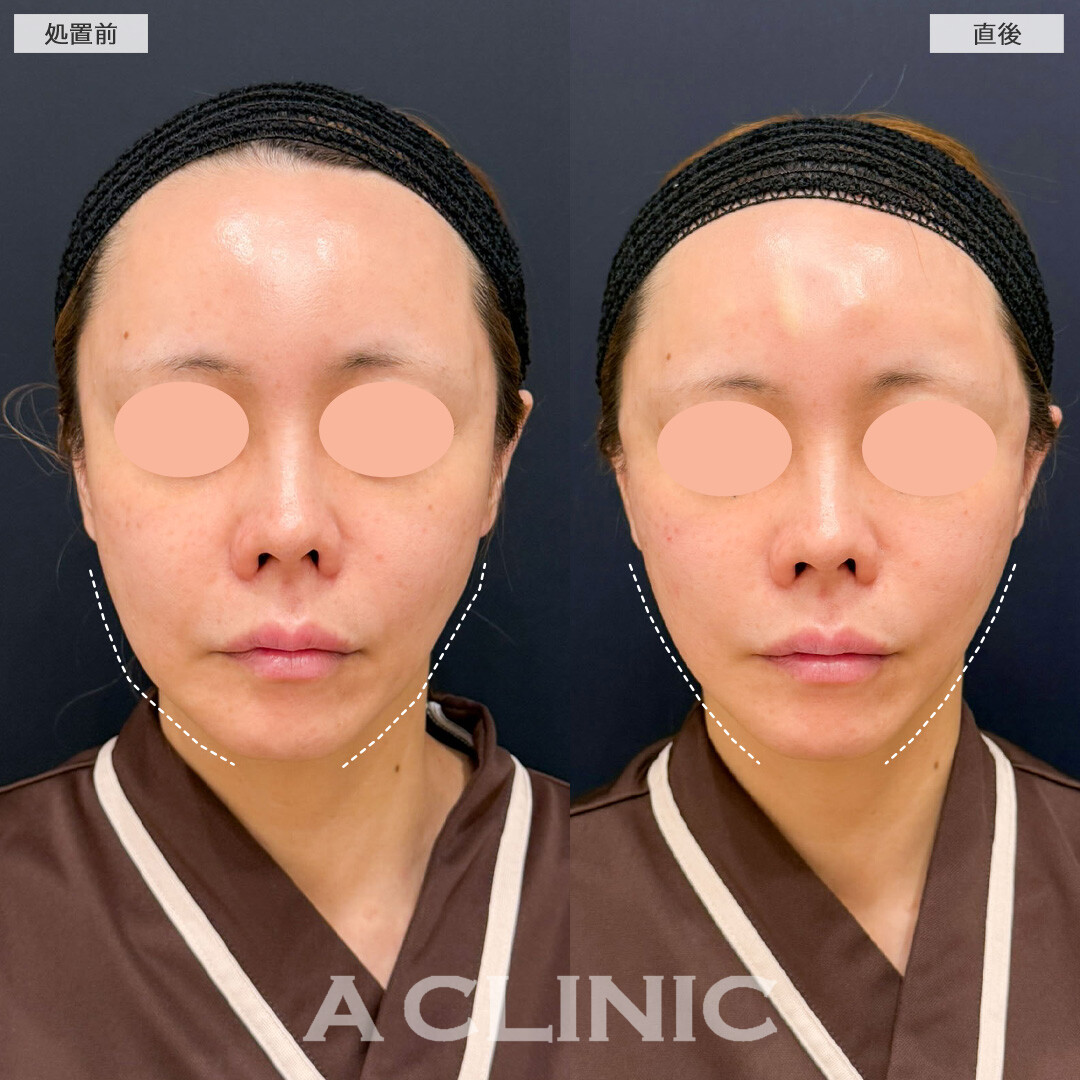 Aスレッドと頬へのヒアルロン酸注入で左右差を整えチークトップが上がり若々しい印象に！こちら処置前と直後の症例です(40代女性)
