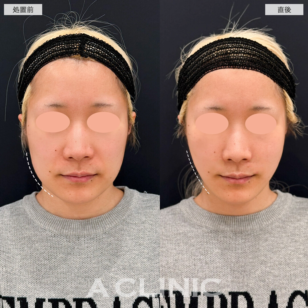 Aスレッドで下ぶくれを解消し卵型輪郭へ！こちら処置前と直後の症例です(30代女性)