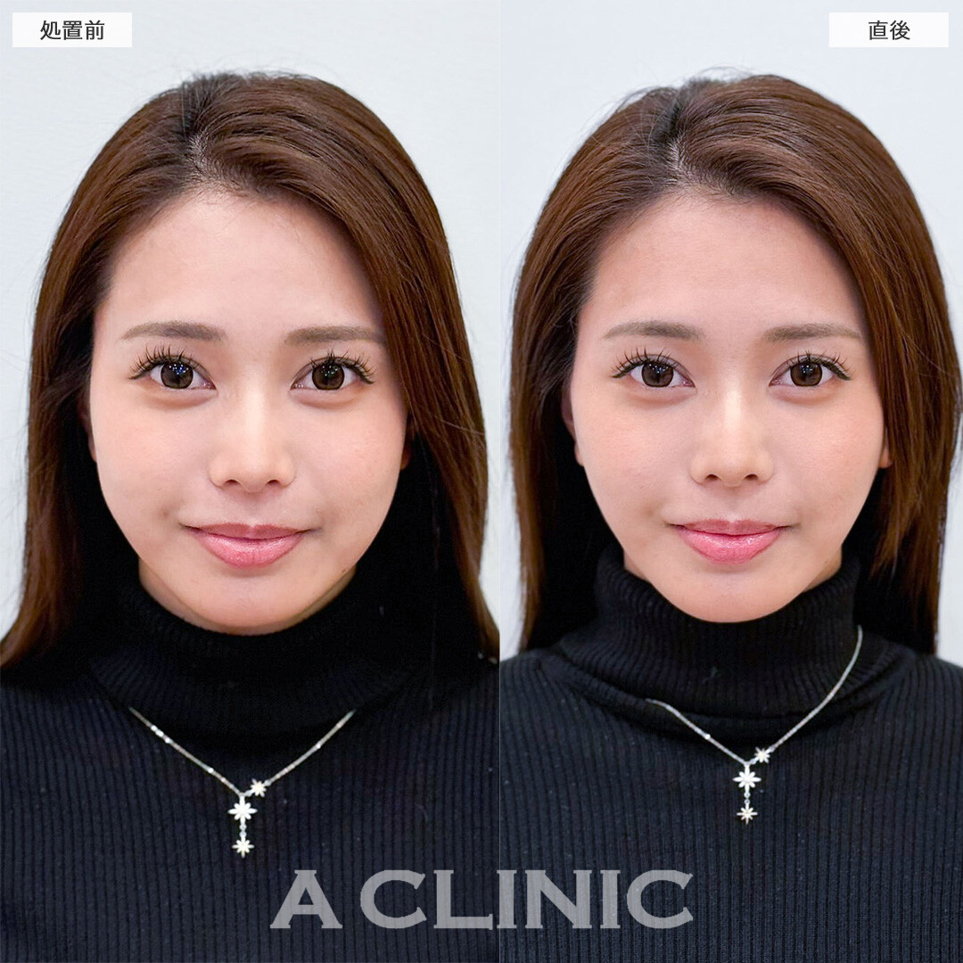 Aスレッドで気になるフェイスラインのもたつき撃退！こちら処置前と直後の症例です(20代女性)