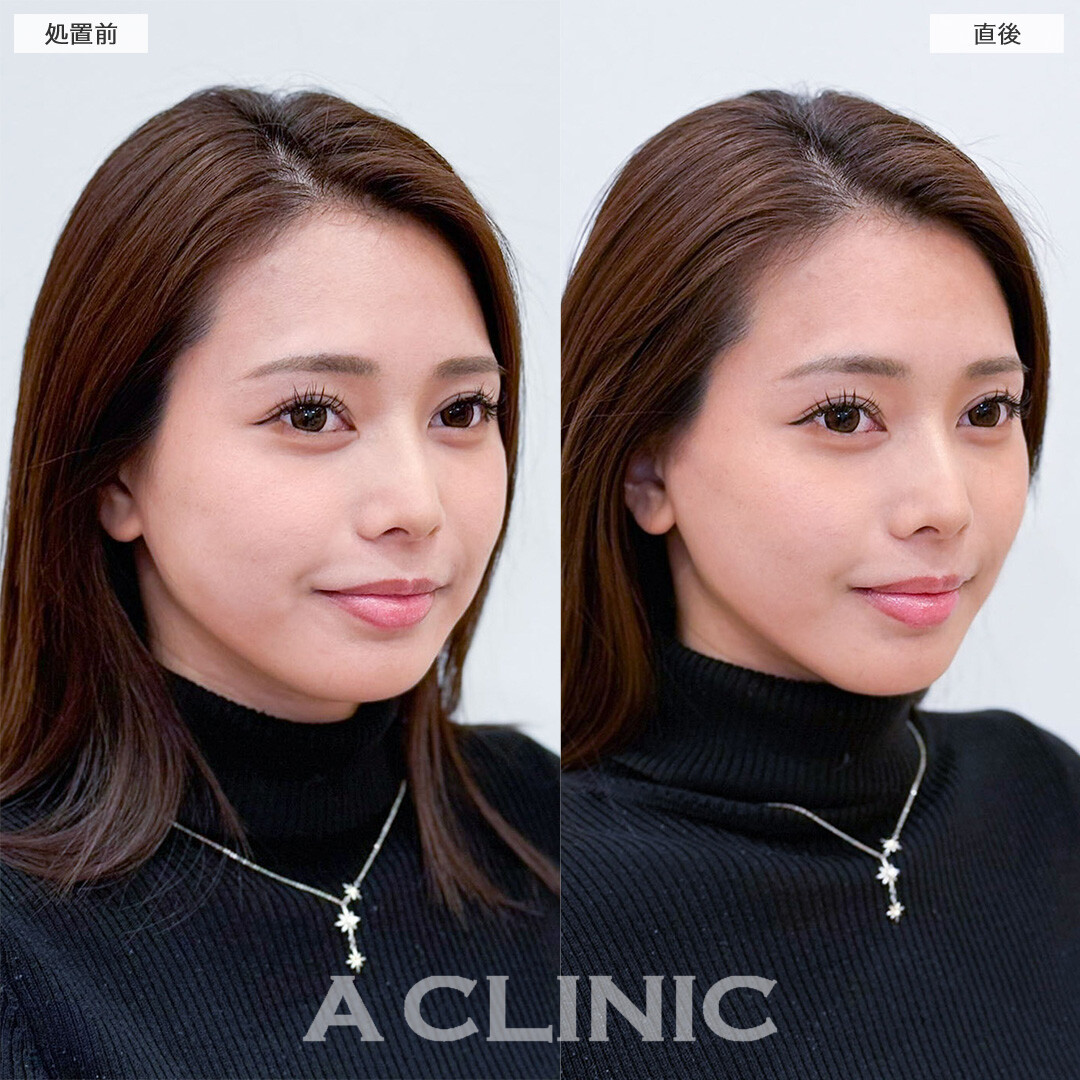 Aスレッドで気になるフェイスラインのもたつき撃退！こちら処置前と直後の症例です(20代女性)