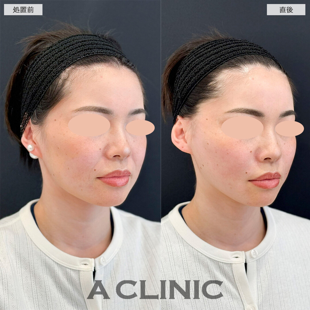 Aスレッドで周りにバレずにたるみ撃退！処置前と直後の症例です(30代女性)