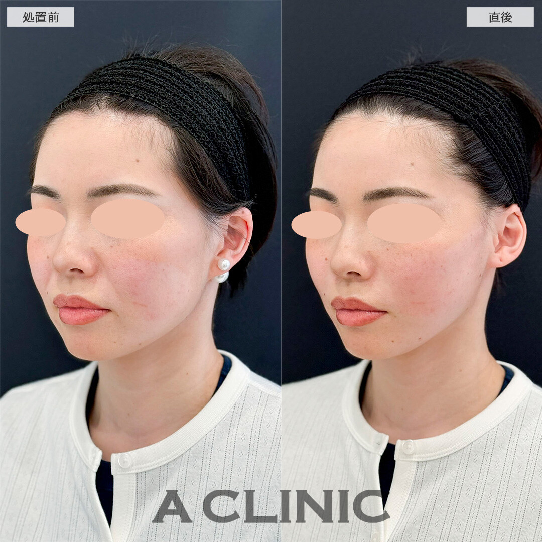Aスレッドで周りにバレずにたるみ撃退！処置前と直後の症例です(30代女性)