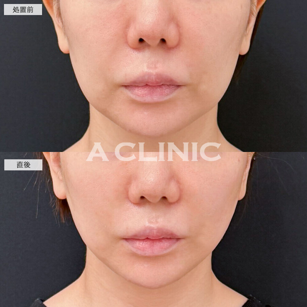 Aスレッドでたるみが引き上がり輪郭が整いました！こちら処置前と直後の症例です(30代女性)