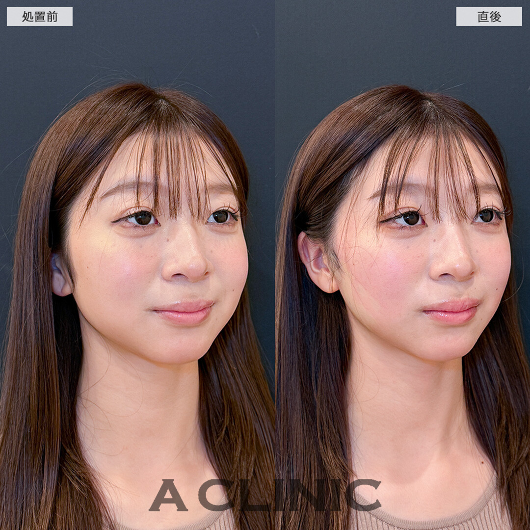 Aスレッドで理想のたまご型の輪郭に！こちら処置前と直後の症例です(20代女性)