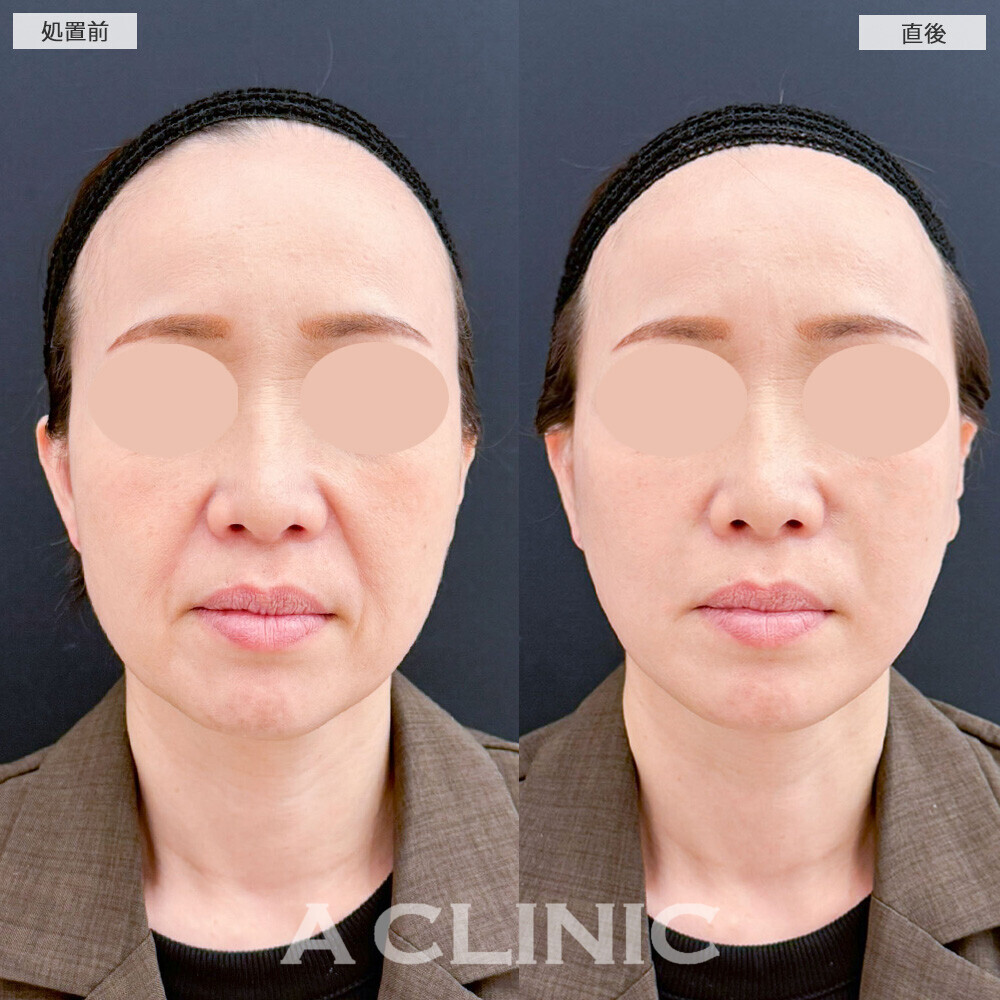 Aスレッドでほうれい線も改善され若返りました！こちら処置前と直後の症例です(40代女性)