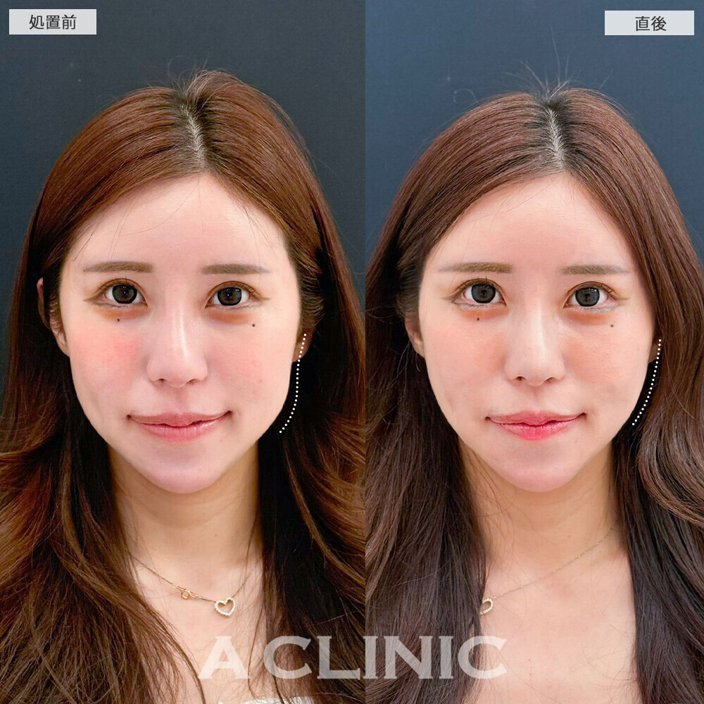 Aスレッドでフェイスラインを整えることで凹凸や面長解消！こちら処置前と直後の症例です