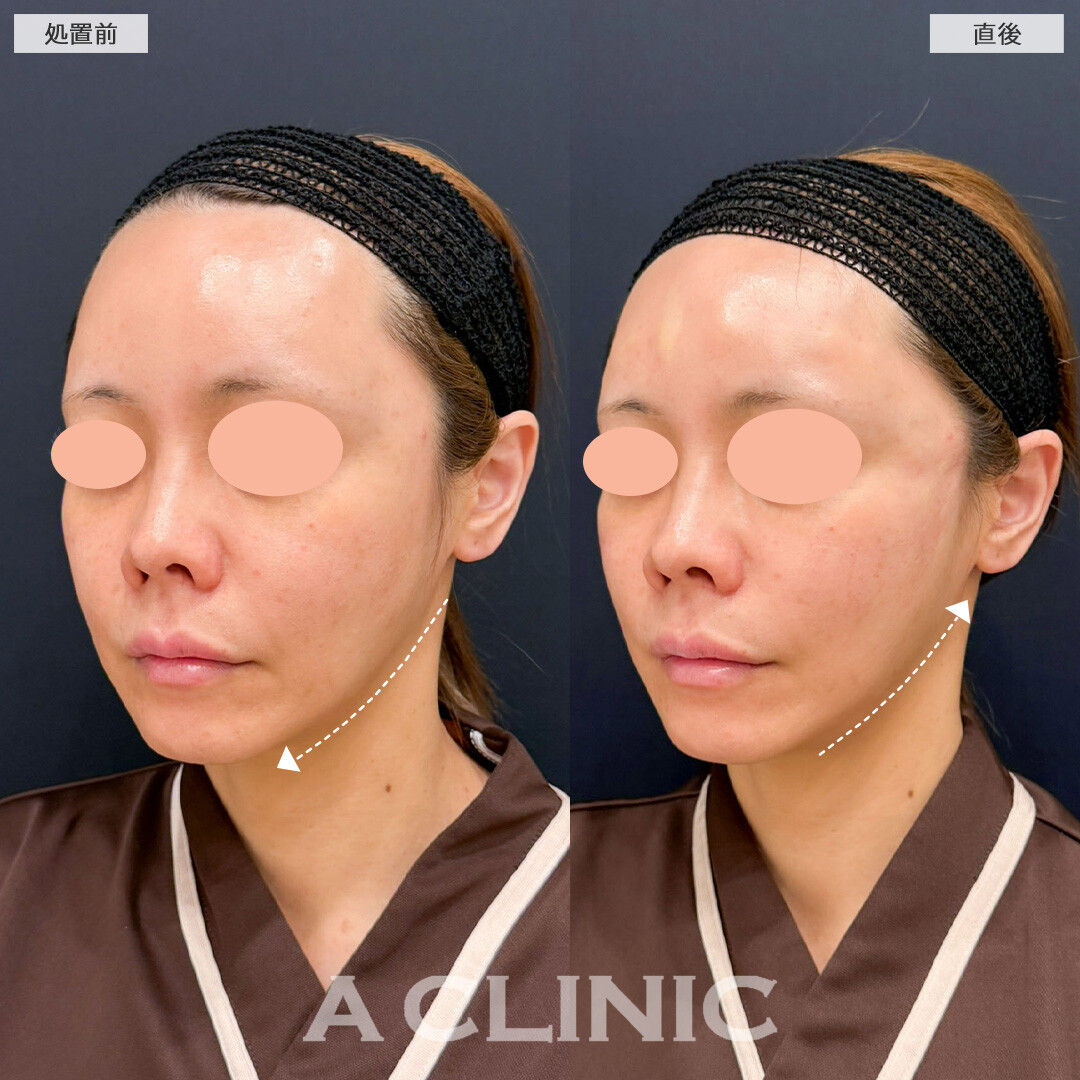 Aスレッドと頬へのヒアルロン酸注入で左右差を整えチークトップが上がり若々しい印象に！こちら処置前と直後の症例です(40代女性)