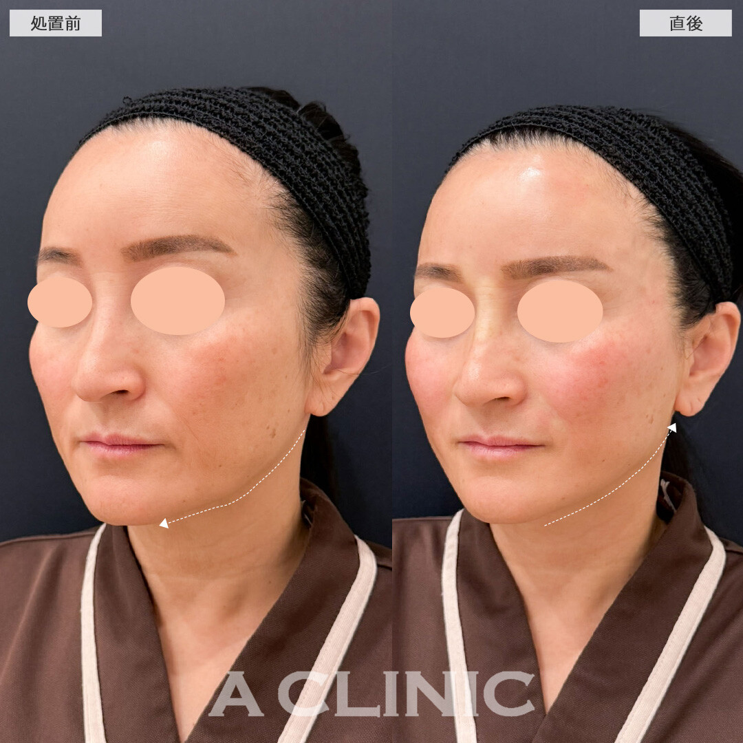 Aスレッドは自然に若返るための賢いたるみ治療です！こちら処置前と直後の症例です(40代女性)