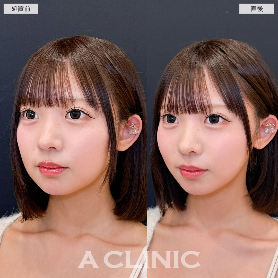 Aスレッドで丸みは残しつつ自然にリフトアップ！こちら処置前と直後の症例です(10代女性)