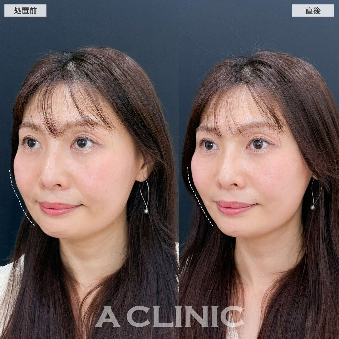 Aスレッドで口元全体のたるみが引きあがり若返りました！こちら処置前と直後の症例です(40代女性)