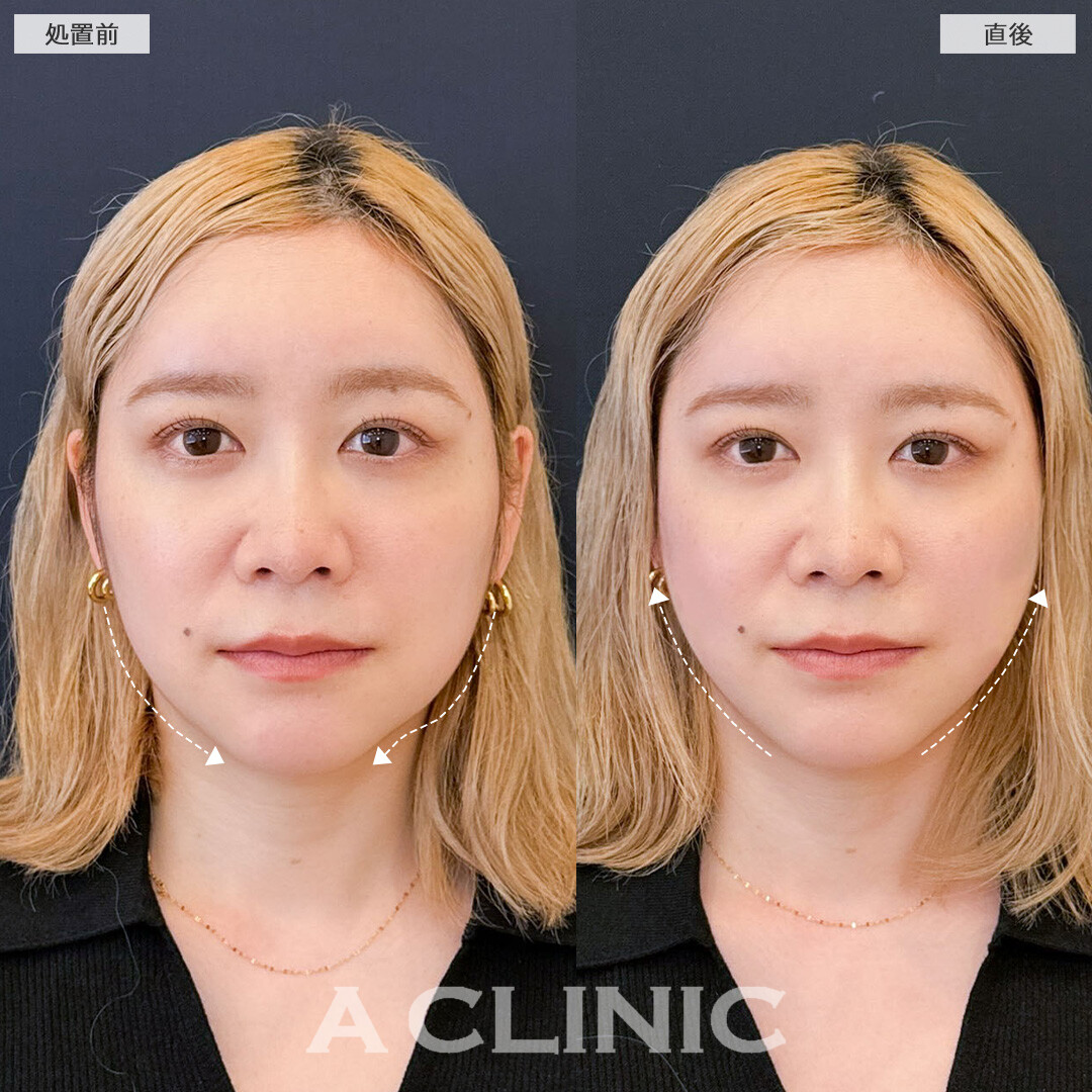 Aスレッドで年齢が出るお顔のたるみを引き上げ若返りました！こちら処置前と直後の症例です(30代女性)