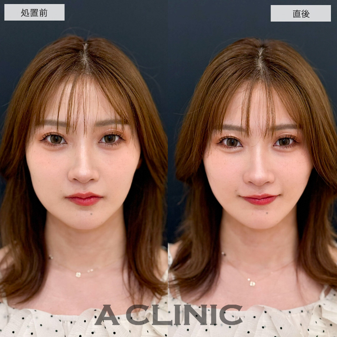 Aスレッドで左右差改善し小顔になることで他のパーツが際立つようになりました!こちら処置前と直後の症例です(20代女性)