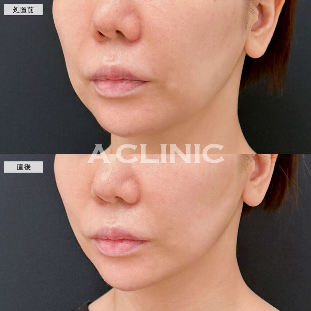 Aスレッドでたるみが引き上がり輪郭が整いました！こちら処置前と直後の症例です(30代女性)