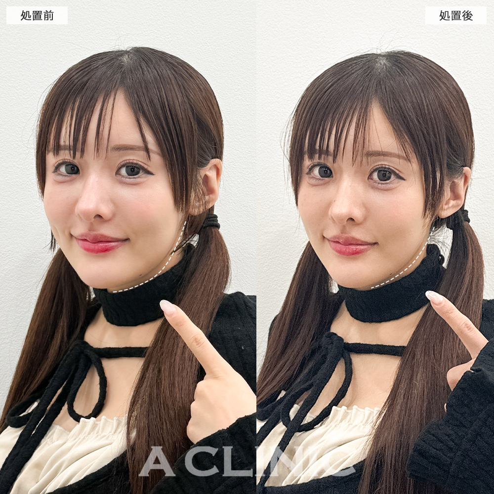 Aスレッドで口横のもたつきが解消し洗練された輪郭に！こちら処置前と直後の症例です(30代女性)
