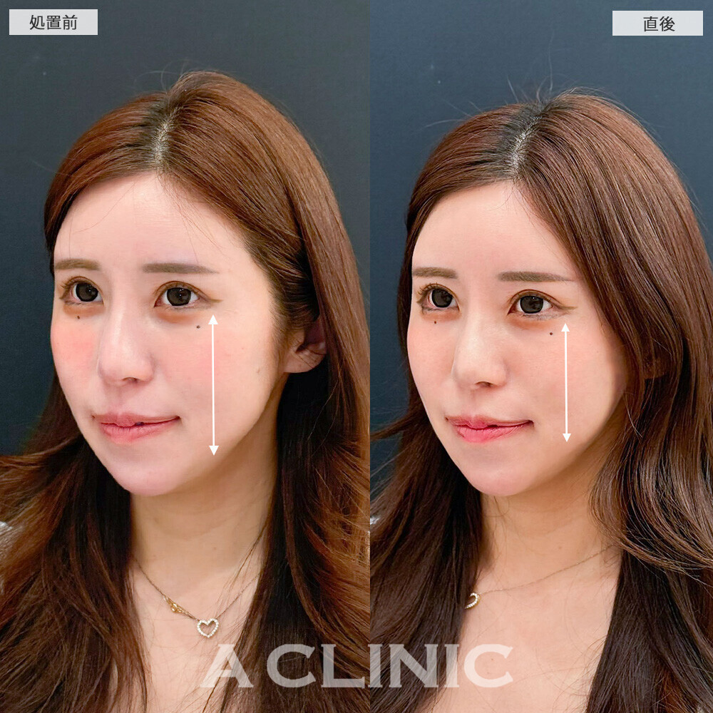 Aスレッドでフェイスラインを整えることで凹凸や面長解消！こちら処置前と直後の症例です