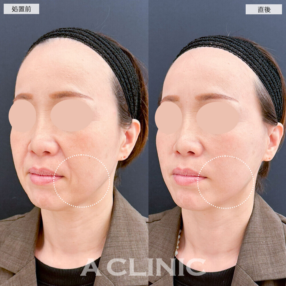 Aスレッドでほうれい線も改善され若返りました！こちら処置前と直後の症例です(40代女性)