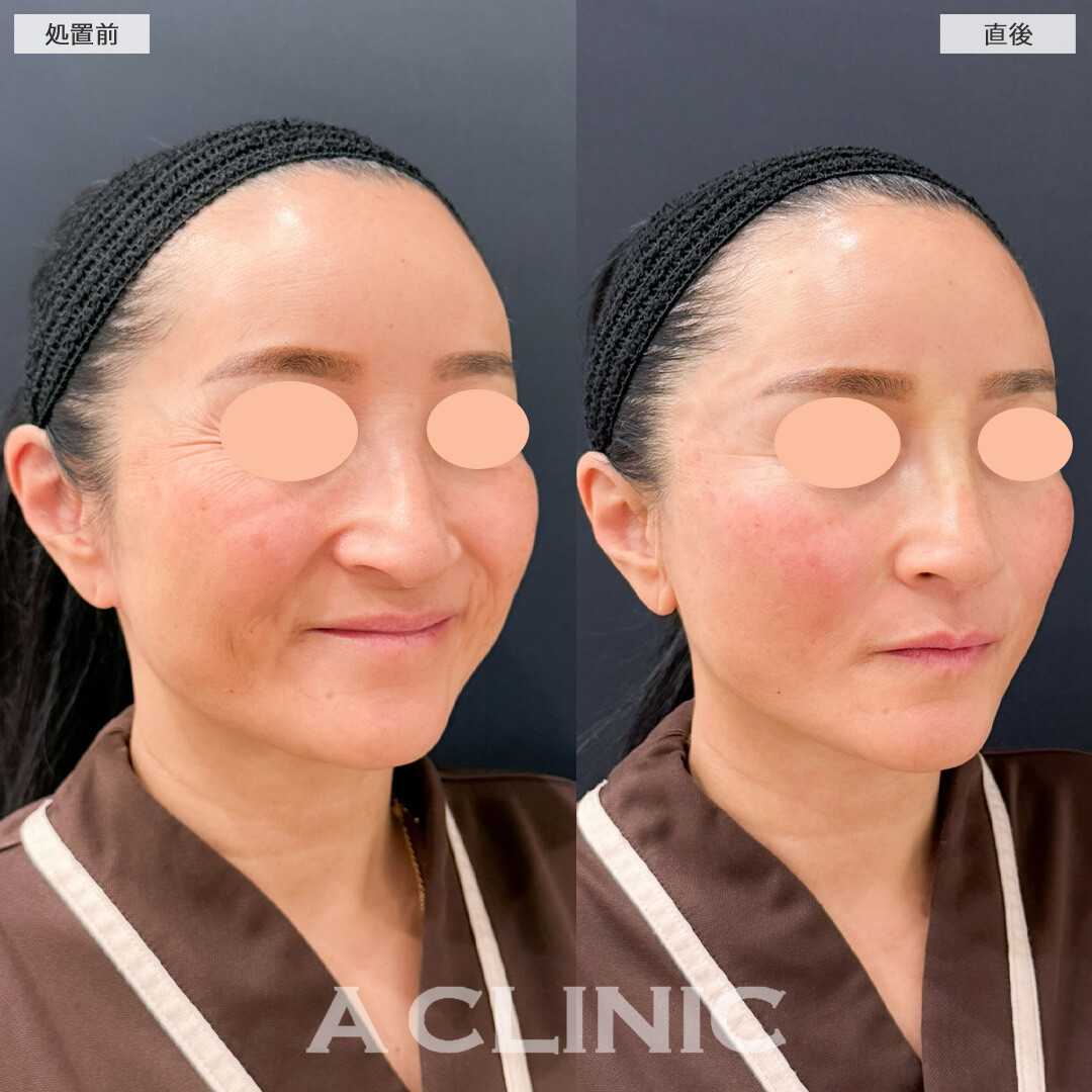 Aスレッドは自然に若返るための賢いたるみ治療です！こちら処置前と直後の症例です(40代女性)