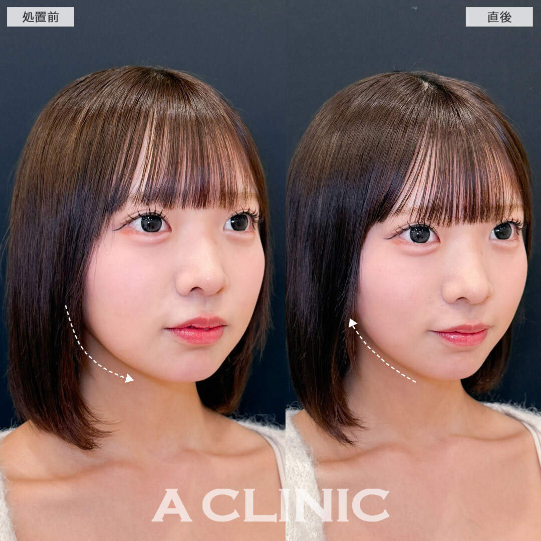Aスレッドで丸みは残しつつ自然にリフトアップ！こちら処置前と直後の症例です(10代女性)