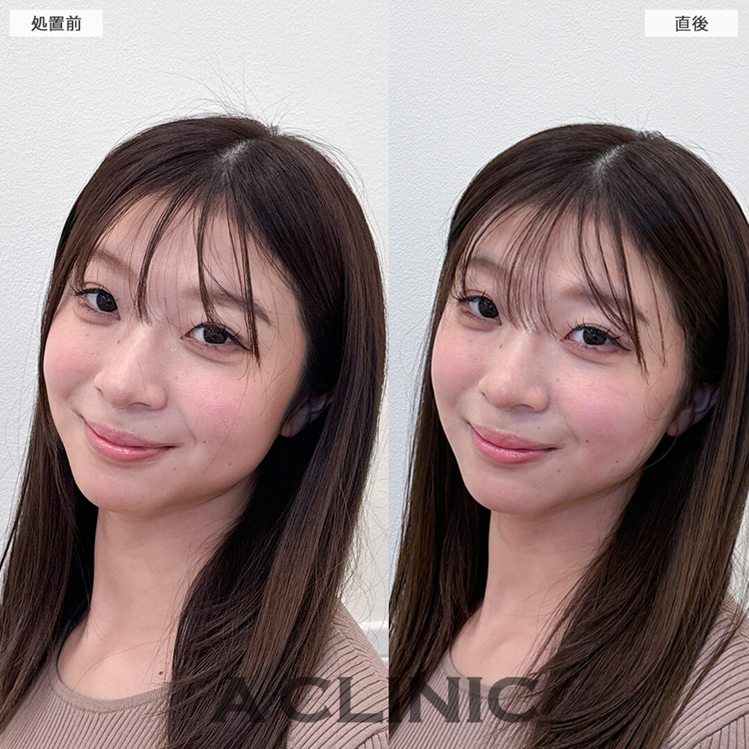 Aスレッドで理想のたまご型の輪郭に！こちら処置前と直後の症例です(20代女性)