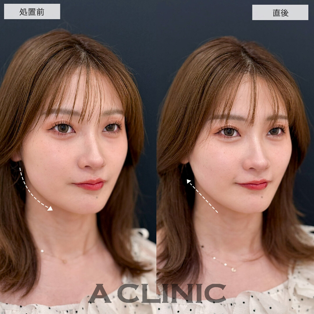 Aスレッドで左右差改善し小顔になることで他のパーツが際立つようになりました!こちら処置前と直後の症例です(20代女性)
