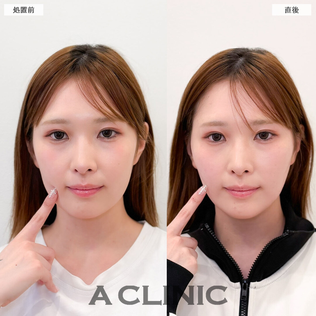 Aスレッドでもたつきを改善しビジュ良くなりました！こちら処置前と直後の症例です(30代女性)