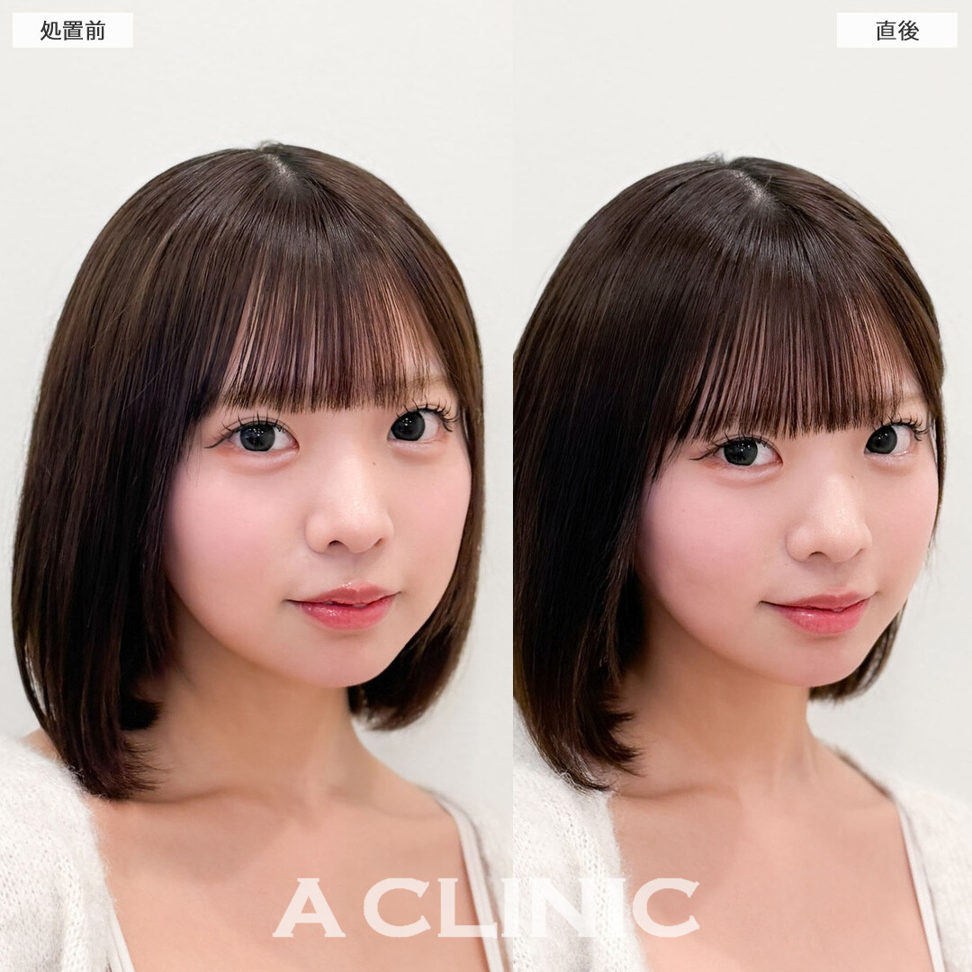 Aスレッドで丸みは残しつつ自然にリフトアップ！こちら処置前と直後の症例です(10代女性)