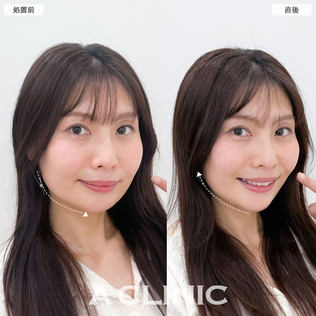 Aスレッドで口元全体のたるみが引きあがり若返りました！こちら処置前と直後の症例です(40代女性)
