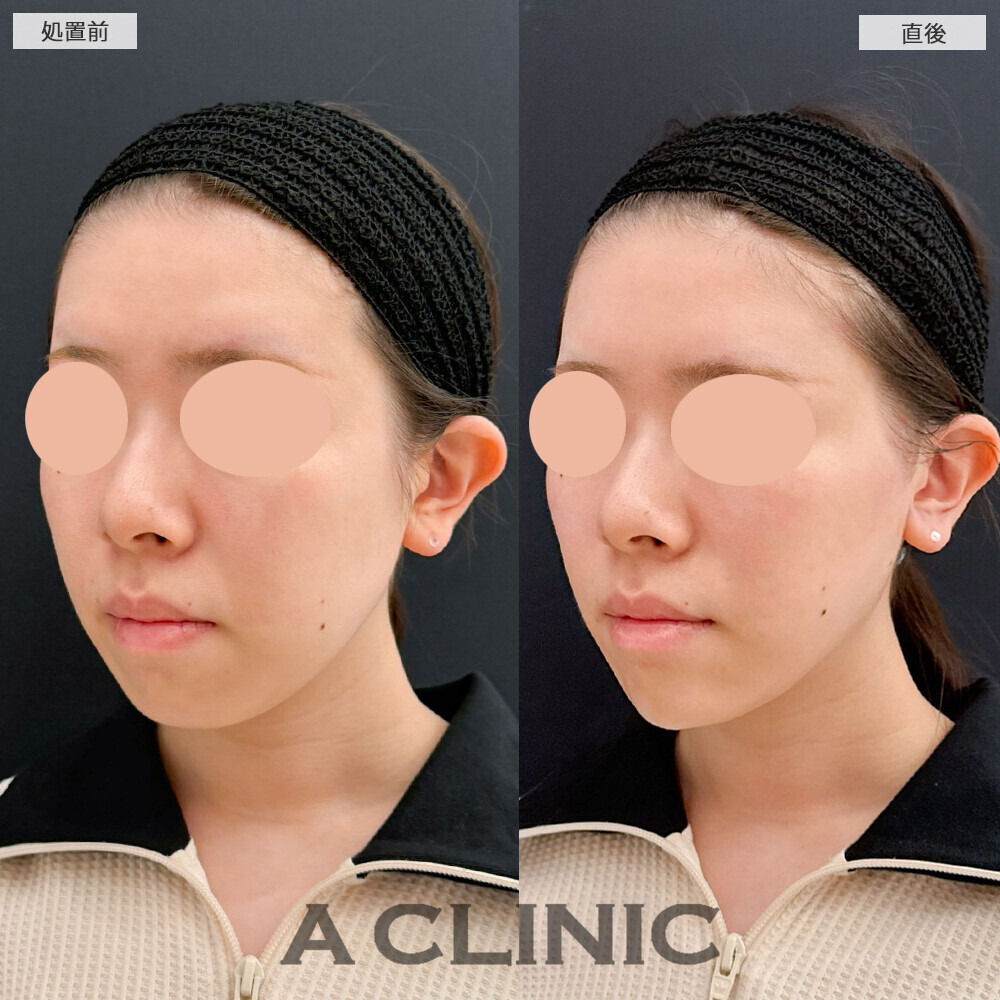 Aスレッドとあごへのヒアルロン酸注入でどの角度から見ても逆三角の輪郭に！こちら処置前と直後の症例です(20代女性)