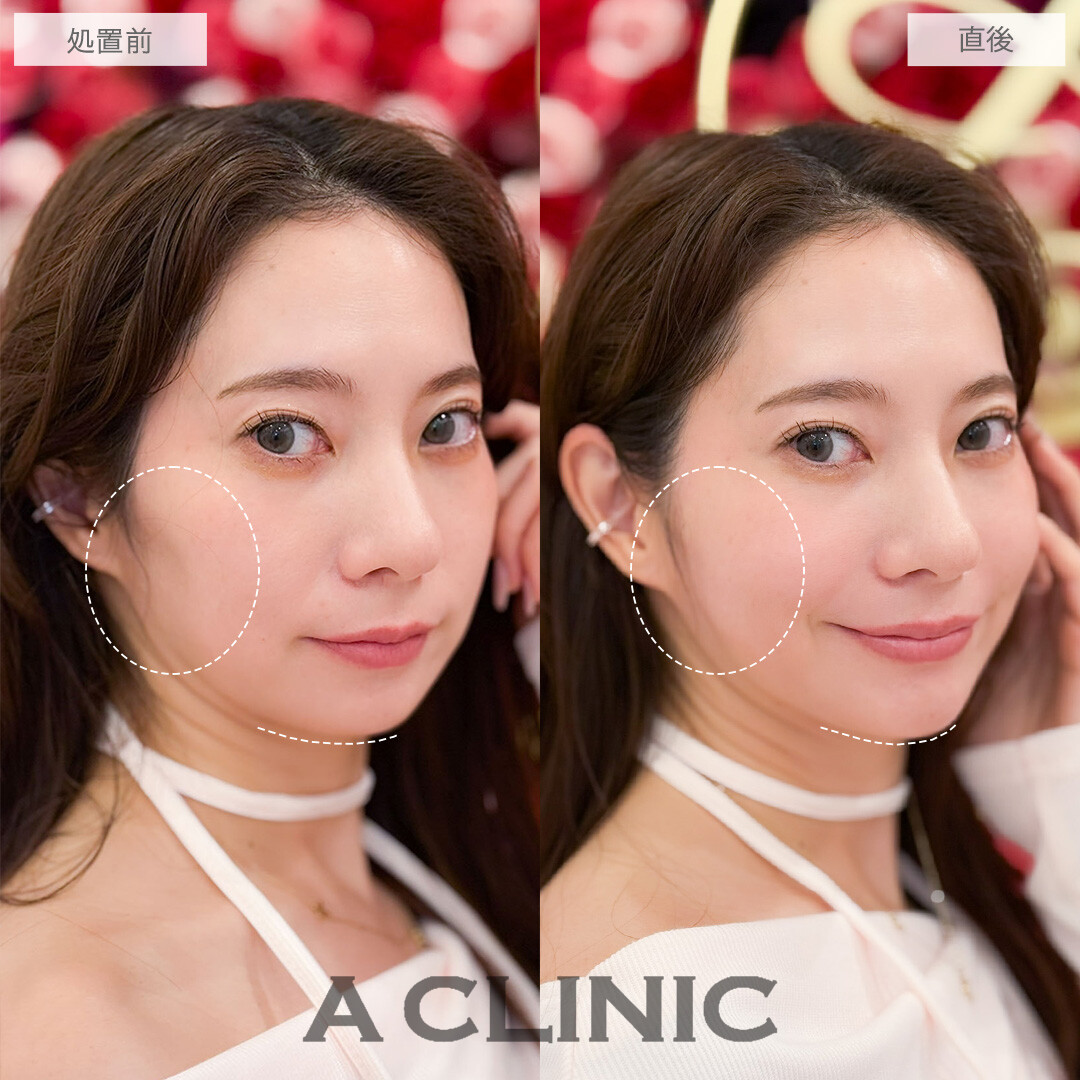 ヒアルロン酸カスタマイズメニューで頬こけとほうれい線が改善しEラインまで整いました！こちら処置前と直後の症例です(30代女性)