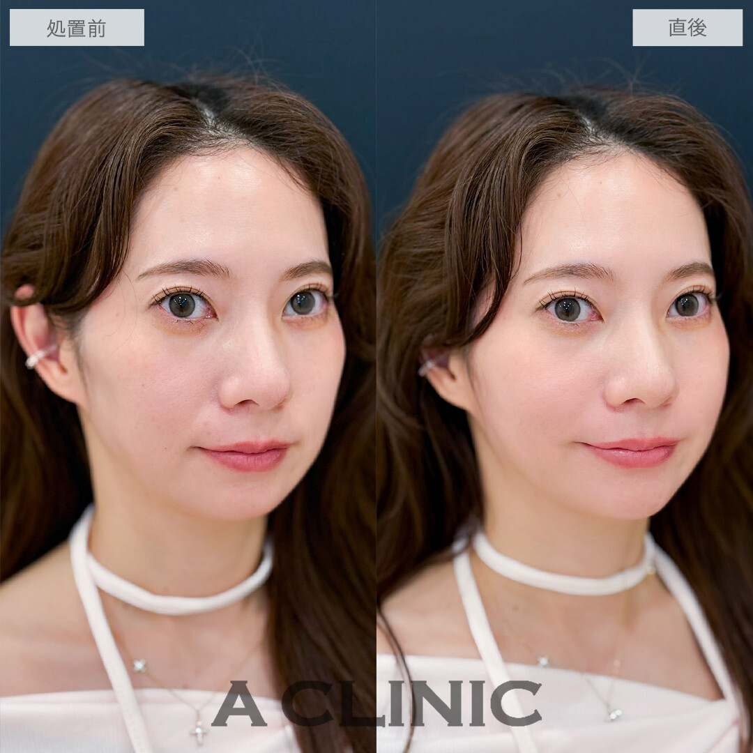 ヒアルロン酸カスタマイズメニューで頬こけとほうれい線が改善しEラインまで整いました！こちら処置前と直後の症例です(30代女性)