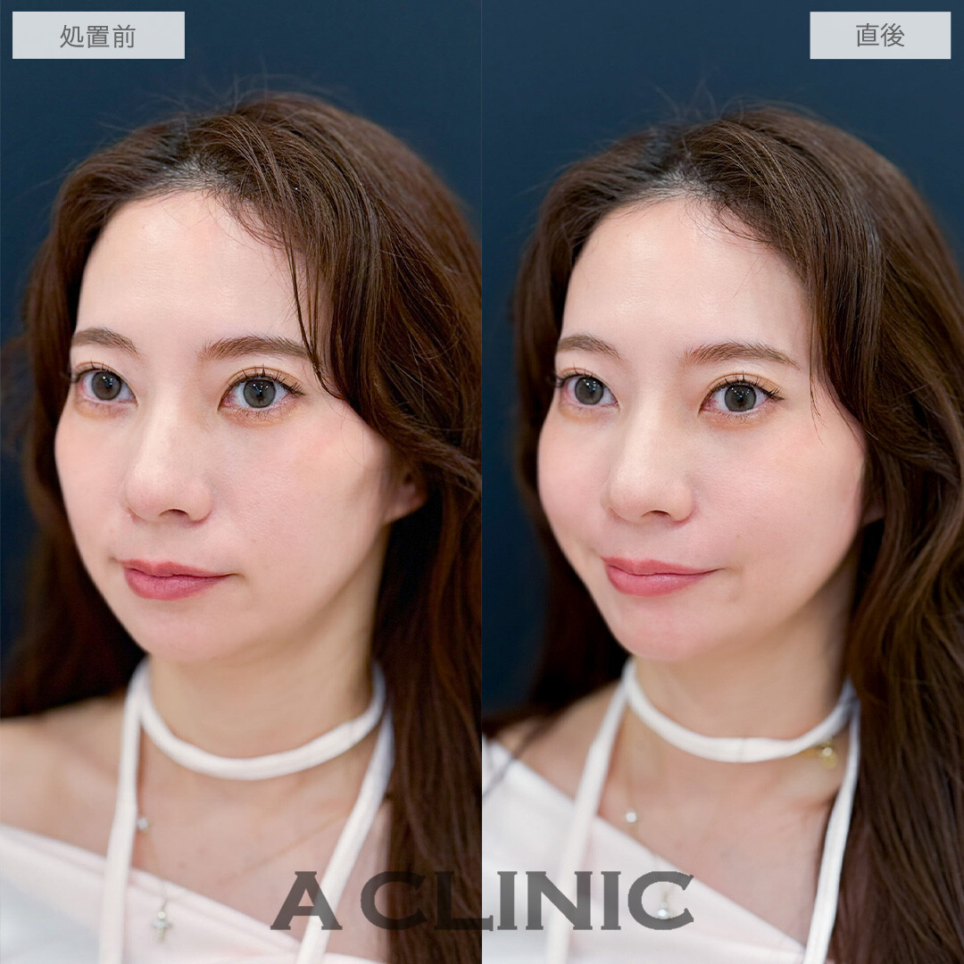 ヒアルロン酸カスタマイズメニューで頬こけとほうれい線が改善しEラインまで整いました！こちら処置前と直後の症例です(30代女性)