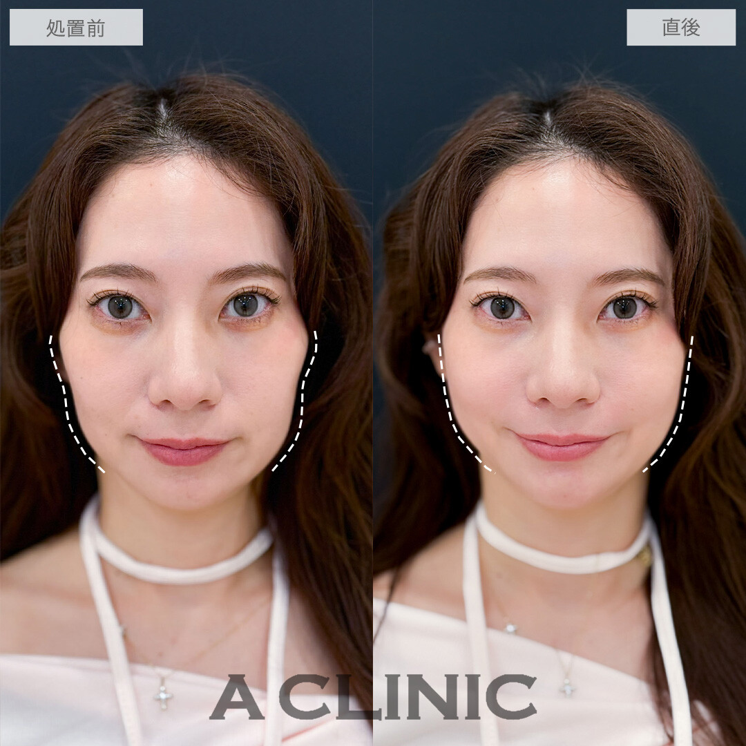 ヒアルロン酸カスタマイズメニューで頬こけとほうれい線が改善しEラインまで整いました！こちら処置前と直後の症例です(30代女性)