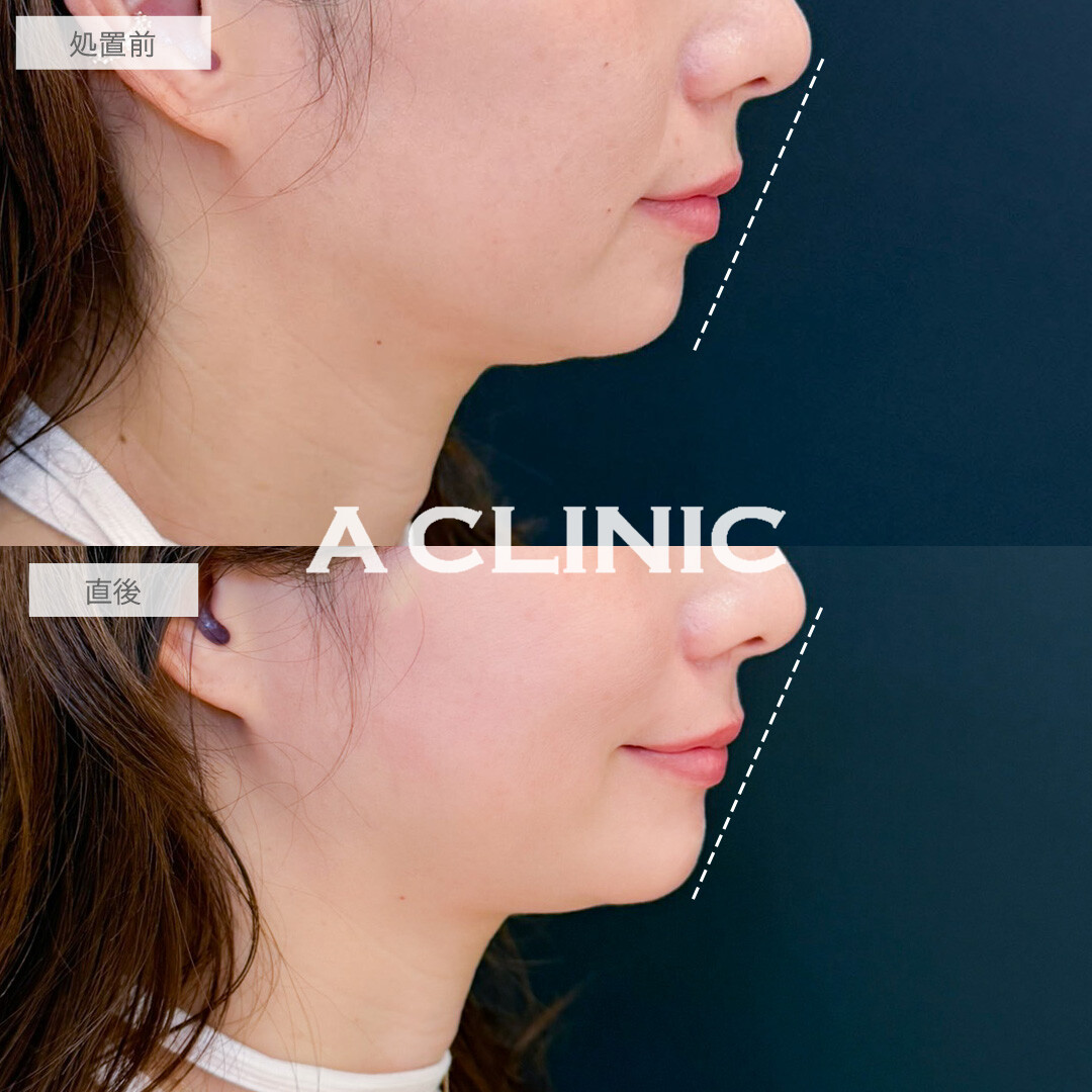 ヒアルロン酸カスタマイズメニューで頬こけとほうれい線が改善しEラインまで整いました！こちら処置前と直後の症例です(30代女性)