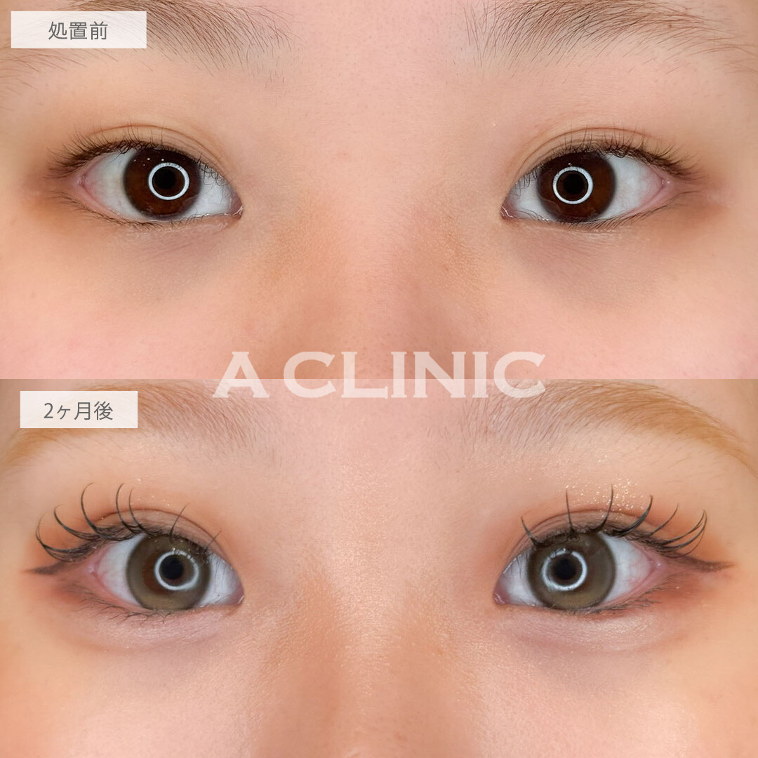 ドーリーアイズでぱっちり二重とぷっくり涙袋が手に入ります！こちら処置前と2ヶ月後の症例です(20代女性)