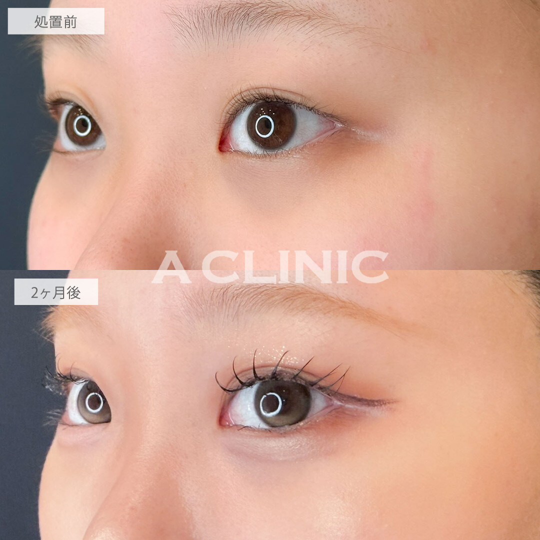 ドーリーアイズでぱっちり二重とぷっくり涙袋が手に入ります！こちら処置前と2ヶ月後の症例です(20代女性)