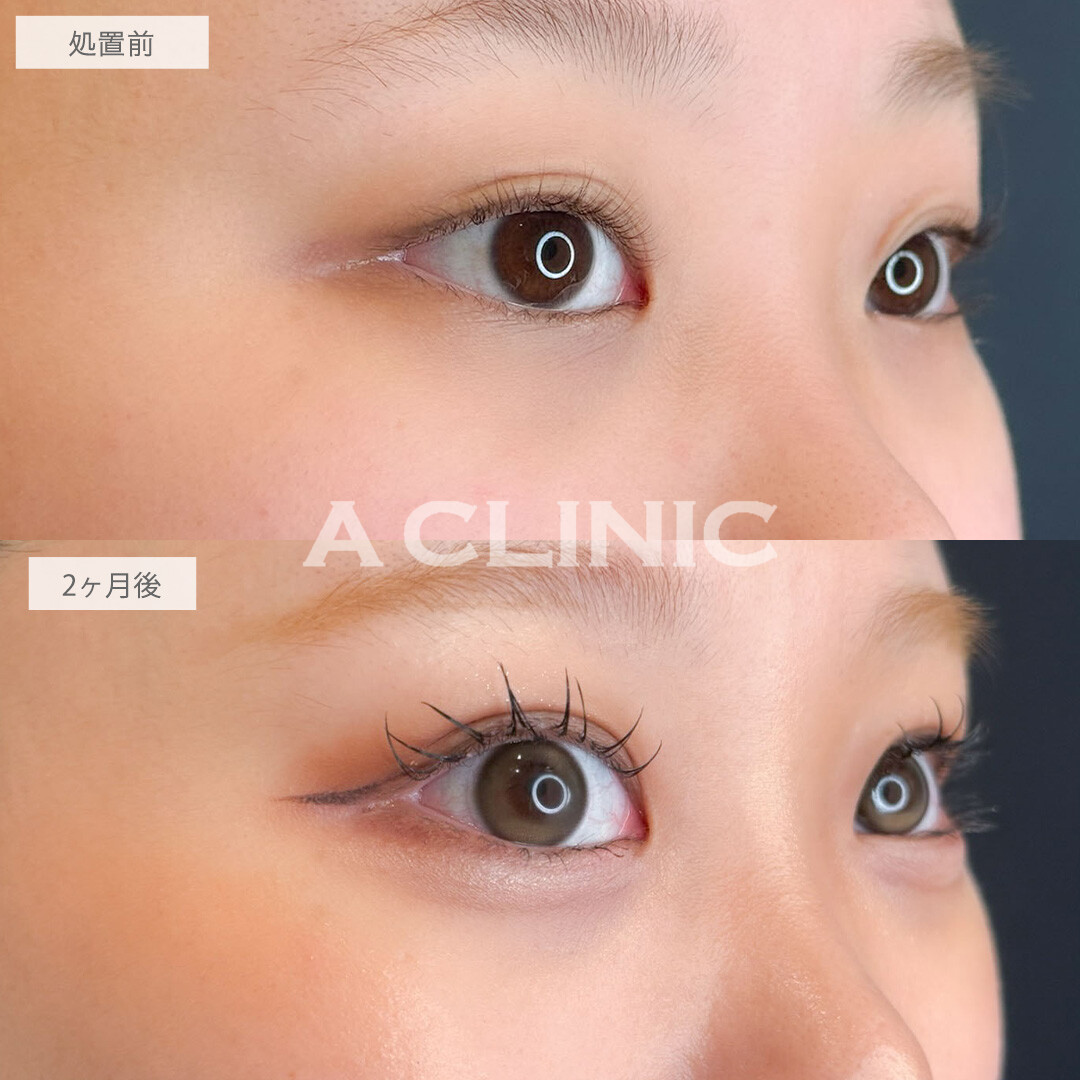 ドーリーアイズでぱっちり二重とぷっくり涙袋が手に入ります！こちら処置前と2ヶ月後の症例です(20代女性)