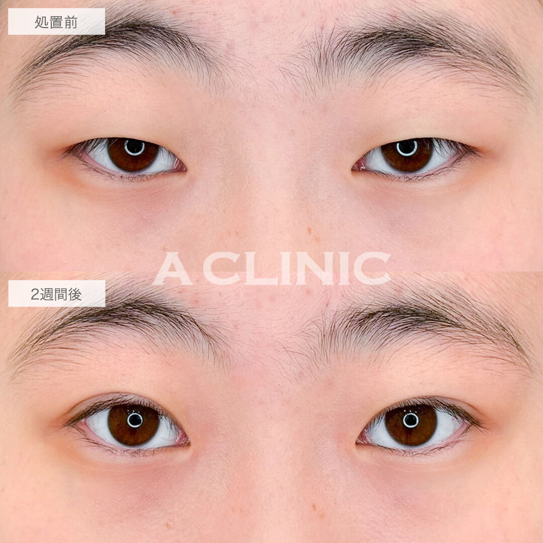 二重術埋没法で目の開きを改善し印象激変！こちら処置前と2週間後の症例です(10代女性)
