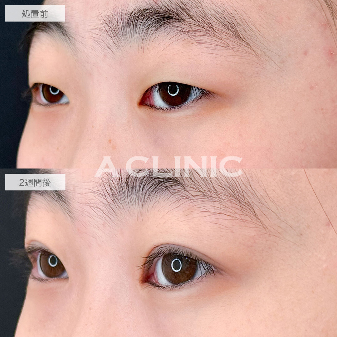 二重術埋没法で目の開きを改善し印象激変！こちら処置前と2週間後の症例です(10代女性)