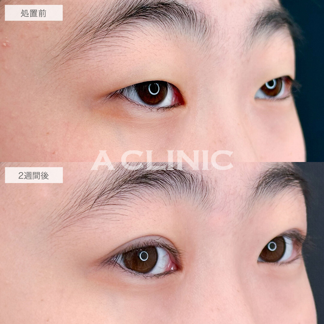 二重術埋没法で目の開きを改善し印象激変！こちら処置前と2週間後の症例です(10代女性)