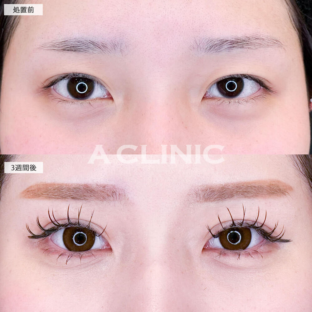 二重術埋没法で目頭側からしっかり二重に！こちら処置前と3週間後の症例です(10代女性)